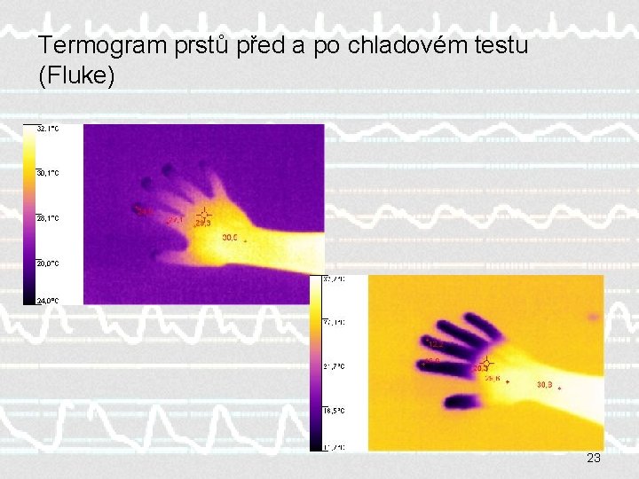 Termogram prstů před a po chladovém testu (Fluke) 23 