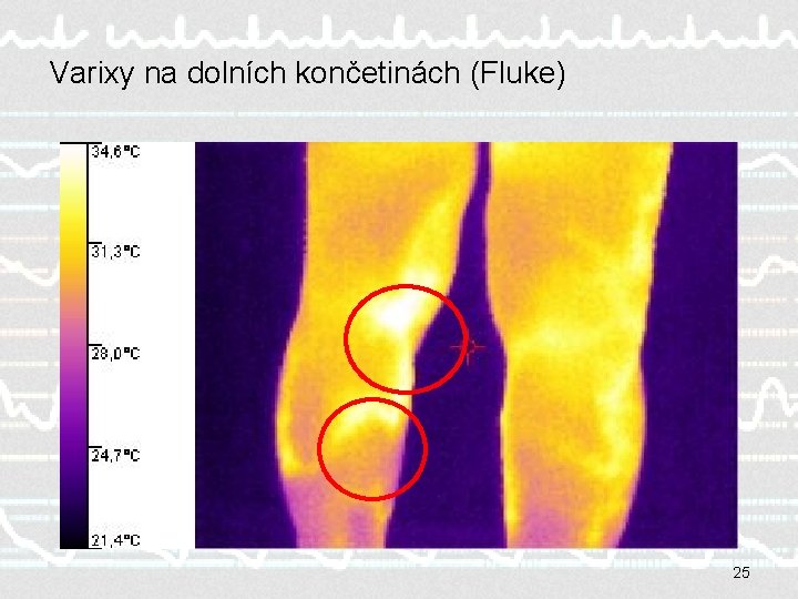 Varixy na dolních končetinách (Fluke) 25 