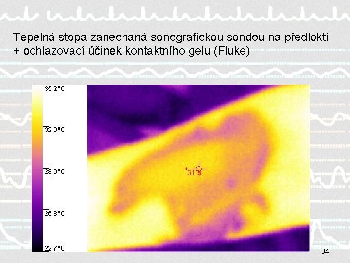 Tepelná stopa zanechaná sonografickou sondou na předloktí + ochlazovací účinek kontaktního gelu (Fluke) 34