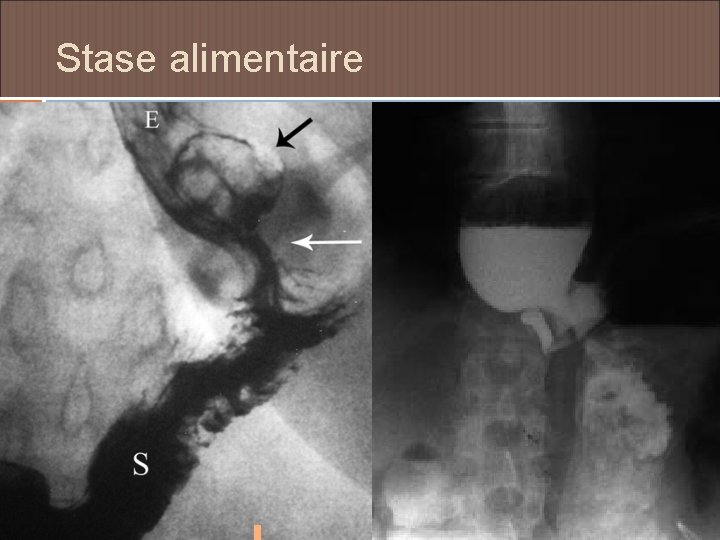 Stase alimentaire 