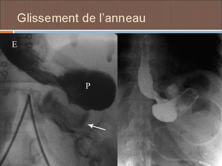 Glissement de l’anneau 