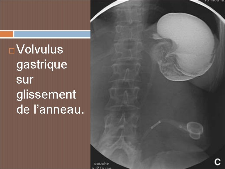  Volvulus gastrique sur glissement de l’anneau. 