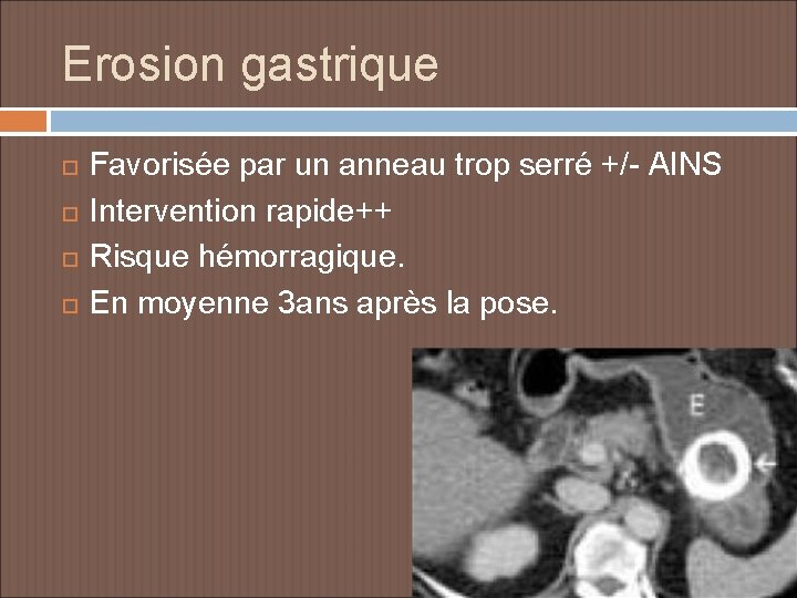 Erosion gastrique Favorisée par un anneau trop serré +/- AINS Intervention rapide++ Risque hémorragique.