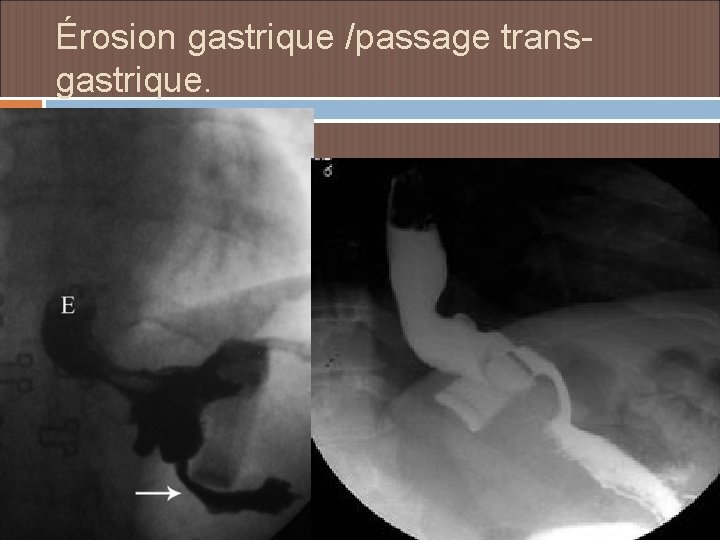 Érosion gastrique /passage transgastrique. 