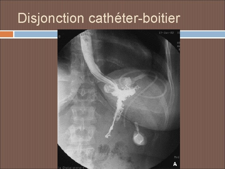 Disjonction cathéter-boitier 