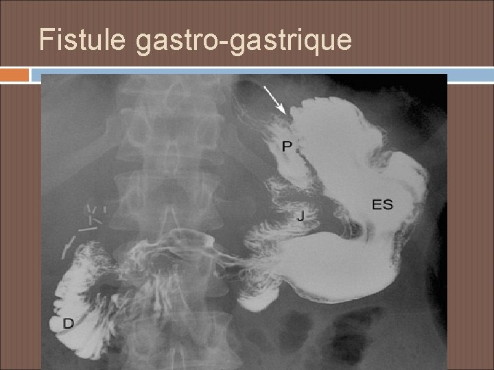 Fistule gastro-gastrique 