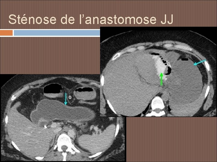 Sténose de l’anastomose JJ 
