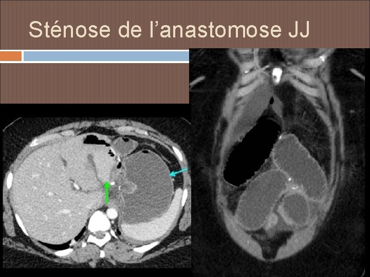 Sténose de l’anastomose JJ 