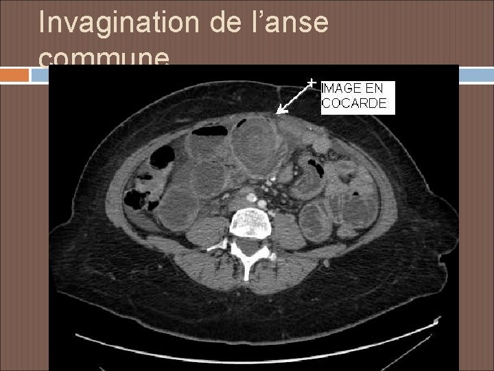 Invagination de l’anse commune 