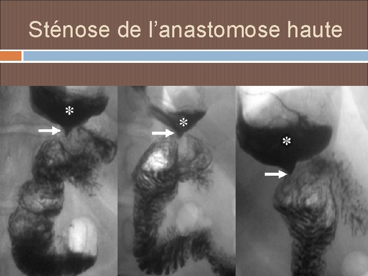 Sténose de l’anastomose haute 