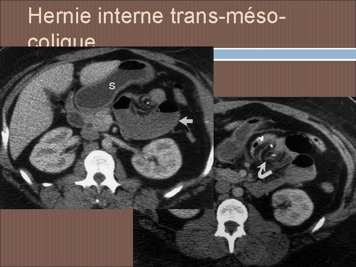 Hernie interne trans-mésocolique 