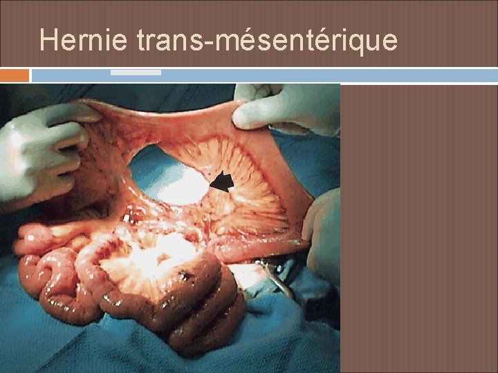 Hernie trans-mésentérique 