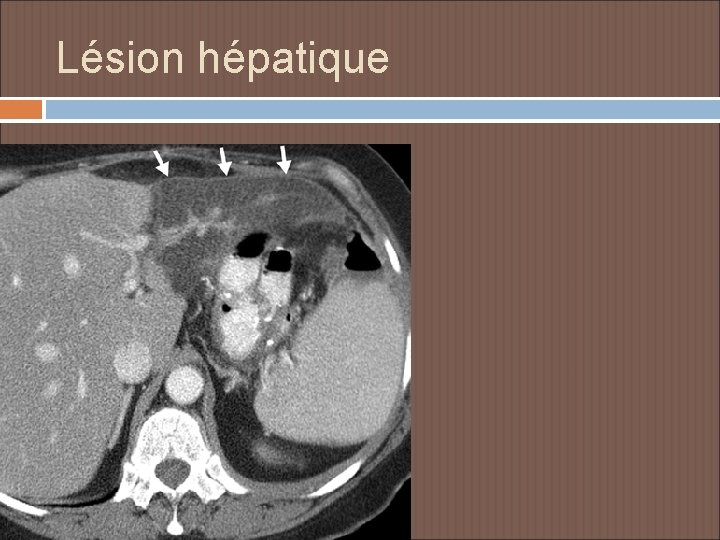 Lésion hépatique 