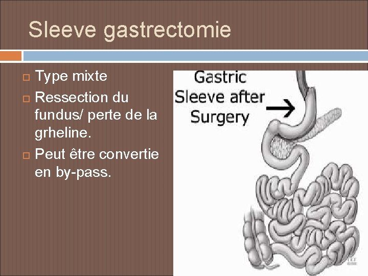 Sleeve gastrectomie Type mixte Ressection du fundus/ perte de la grheline. Peut être convertie
