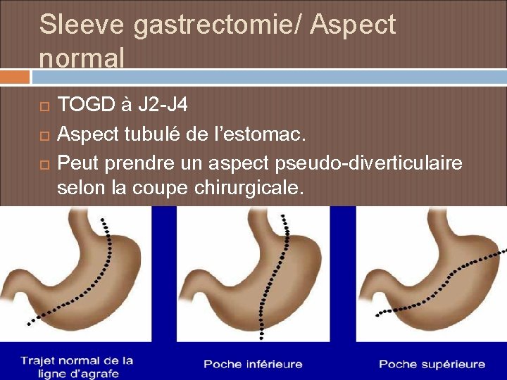 Sleeve gastrectomie/ Aspect normal TOGD à J 2 -J 4 Aspect tubulé de l’estomac.
