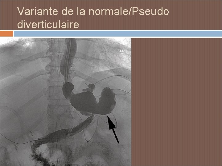 Variante de la normale/Pseudo diverticulaire 