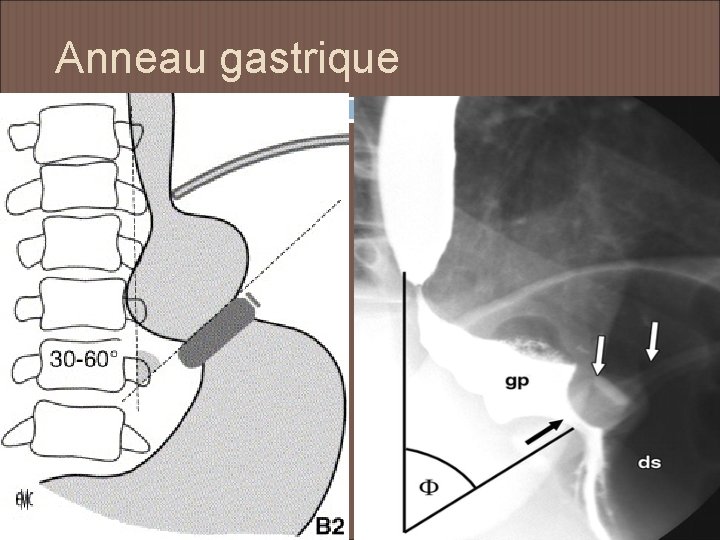 Anneau gastrique 