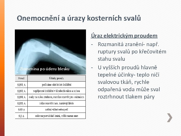 Onemocnění a úrazy kosterních svalů Zlomenina po úderu blesku Úraz elektrickým proudem - Rozmanitá