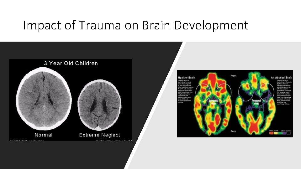 Impact of Trauma on Brain Development 