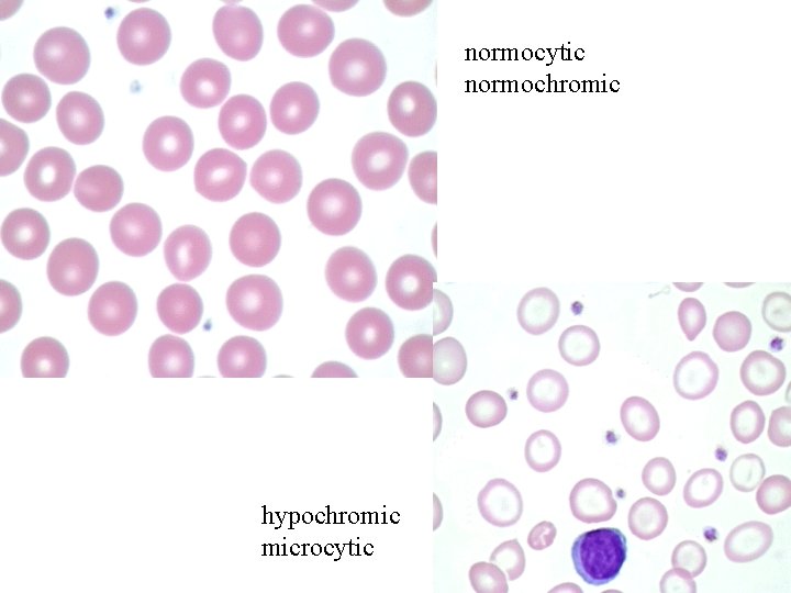 normocytic normochromic hypochromic microcytic 