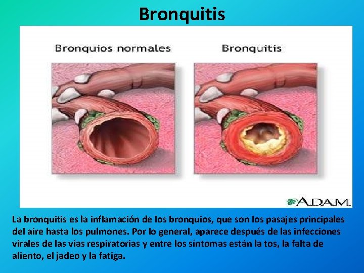 Bronquitis La bronquitis es la inflamación de los bronquios, que son los pasajes principales