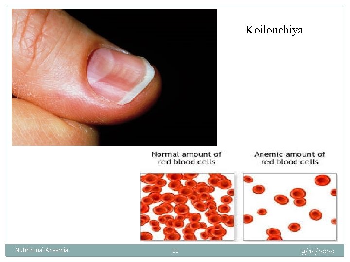 Koilonchiya Nutritional Anaemia 11 9/10/2020 