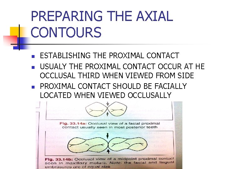 PREPARING THE AXIAL CONTOURS n n n ESTABLISHING THE PROXIMAL CONTACT USUALY THE PROXIMAL