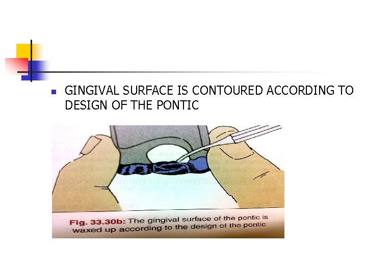 n GINGIVAL SURFACE IS CONTOURED ACCORDING TO DESIGN OF THE PONTIC 
