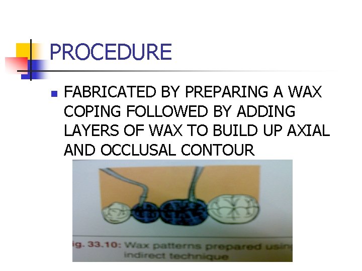 PROCEDURE n FABRICATED BY PREPARING A WAX COPING FOLLOWED BY ADDING LAYERS OF WAX
