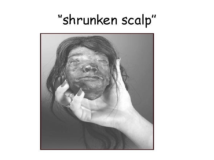 ‘’shrunken scalp’’ 