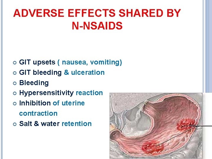 ADVERSE EFFECTS SHARED BY N-NSAIDS GIT upsets ( nausea, vomiting) GIT bleeding & ulceration