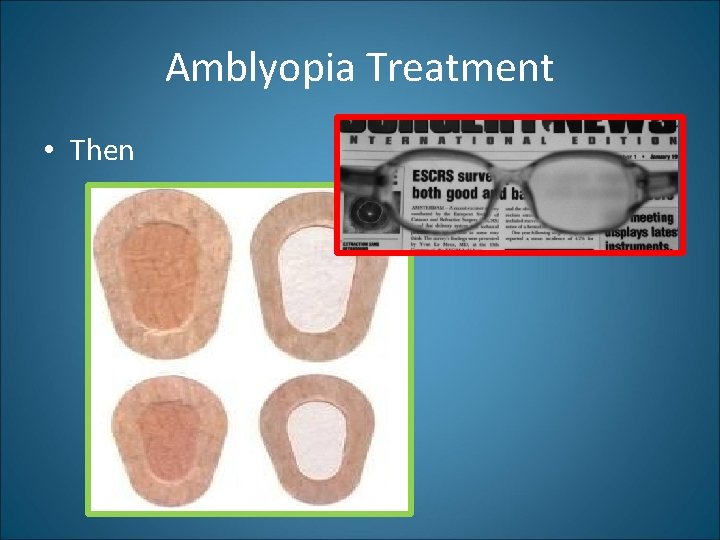 Amblyopia Treatment • Then 