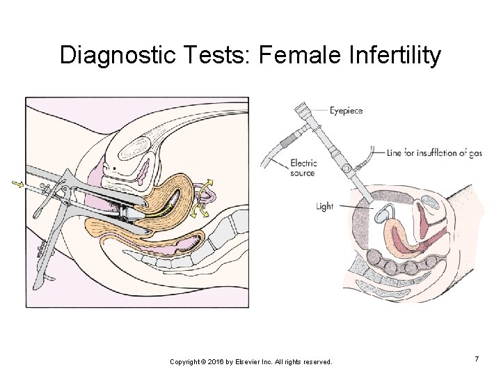 Diagnostic Tests: Female Infertility Copyright © 2016 by Elsevier Inc. All rights reserved. 7