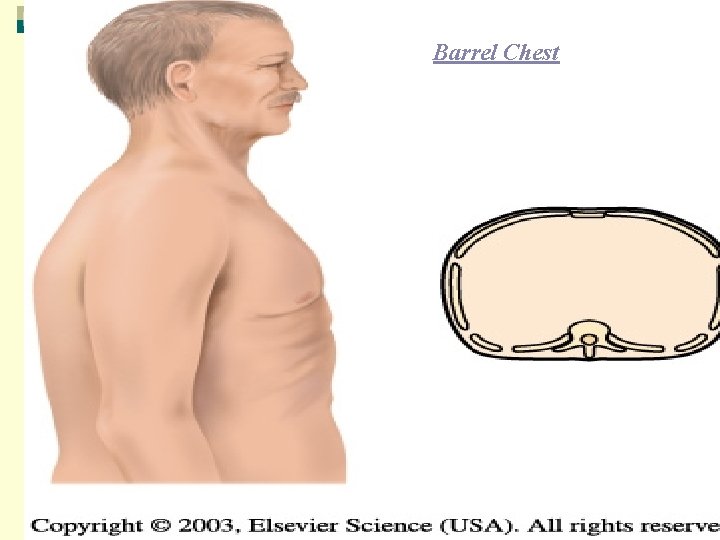 Barrel Chest 