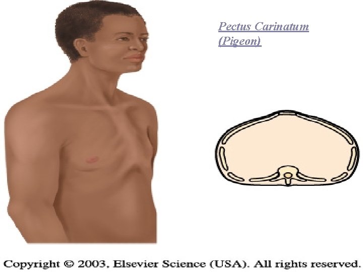 Pectus Carinatum (Pigeon) 