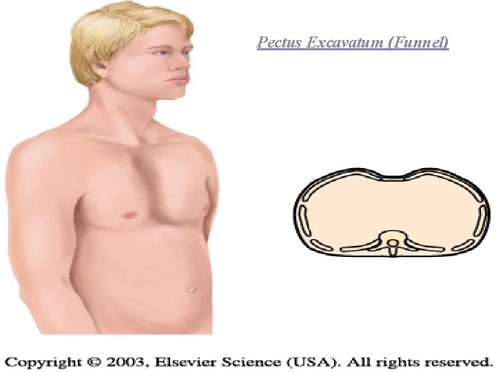 Pectus Excavatum (Funnel) 