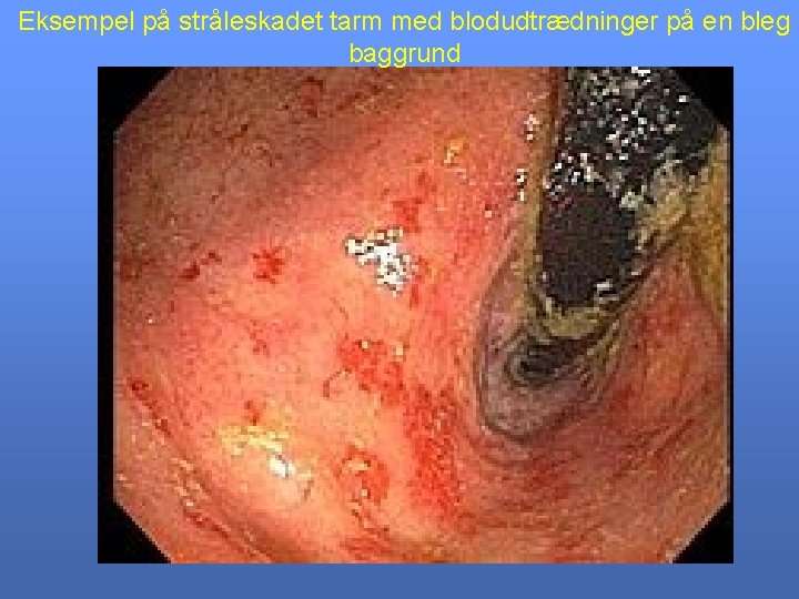 Eksempel på stråleskadet tarm med blodudtrædninger på en bleg baggrund 