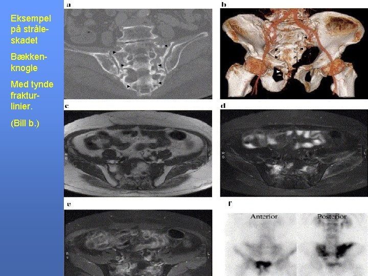 Eksempel på stråleskadet Bækkenknogle Med tynde frakturlinier. (Bill b. ) 