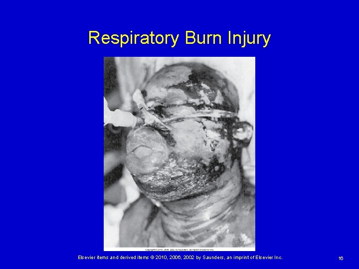 Respiratory Burn Injury Elsevier items and derived items © 2010, 2006, 2002 by Saunders,