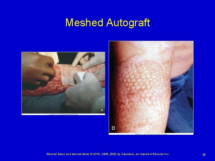 Meshed Autograft Elsevier items and derived items © 2010, 2006, 2002 by Saunders, an