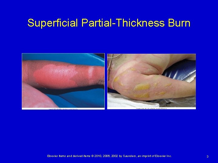Superficial Partial-Thickness Burn Elsevier items and derived items © 2010, 2006, 2002 by Saunders,