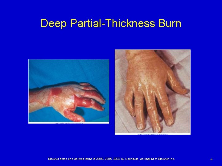 Deep Partial-Thickness Burn Elsevier items and derived items © 2010, 2006, 2002 by Saunders,