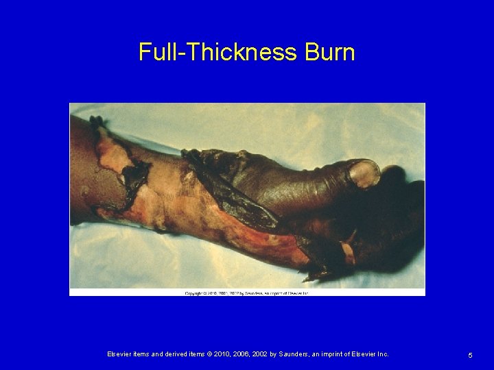 Full-Thickness Burn Elsevier items and derived items © 2010, 2006, 2002 by Saunders, an