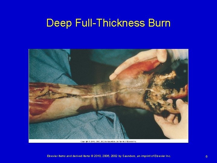 Deep Full-Thickness Burn Elsevier items and derived items © 2010, 2006, 2002 by Saunders,