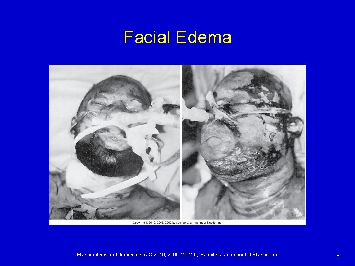 Facial Edema Elsevier items and derived items © 2010, 2006, 2002 by Saunders, an