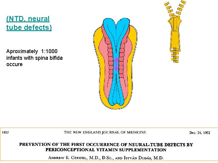 (NTD, neural tube defects) Aproximately 1: 1000 infants with spina bifida occure 