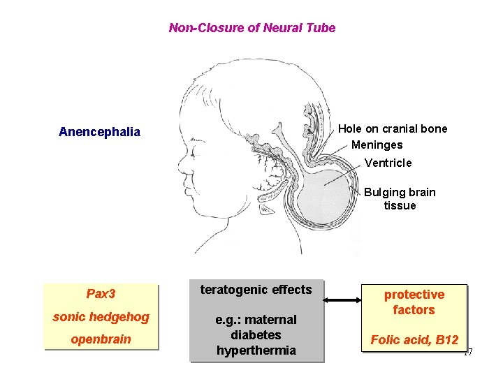 Non-Closure of Neural Tube Hole on cranial bone Meninges Anencephalia Ventricle Bulging brain tissue