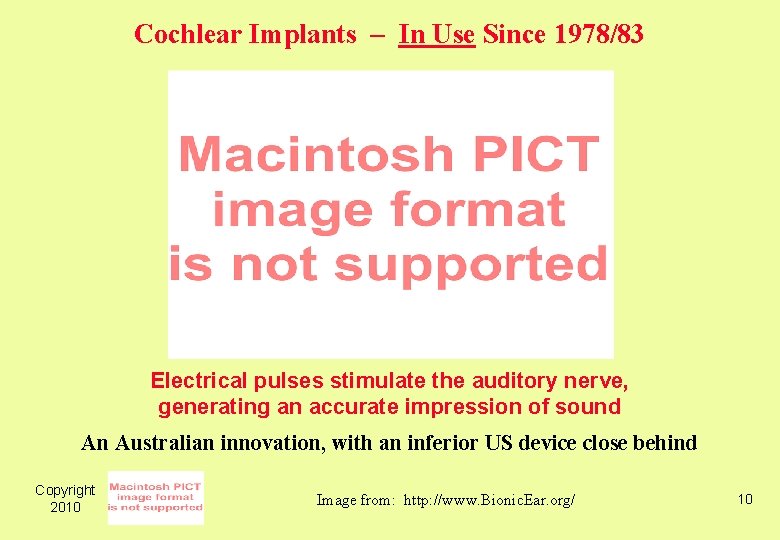 Cochlear Implants – In Use Since 1978/83 Electrical pulses stimulate the auditory nerve, generating