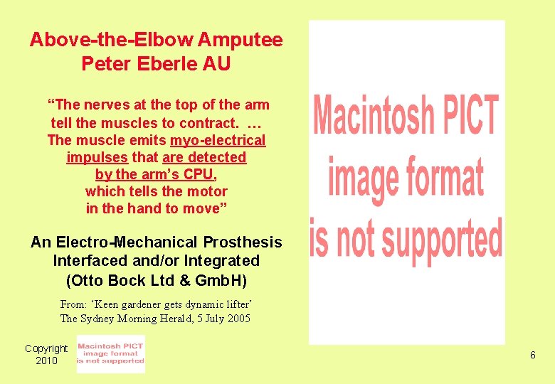 Above-the-Elbow Amputee Peter Eberle AU “The nerves at the top of the arm tell