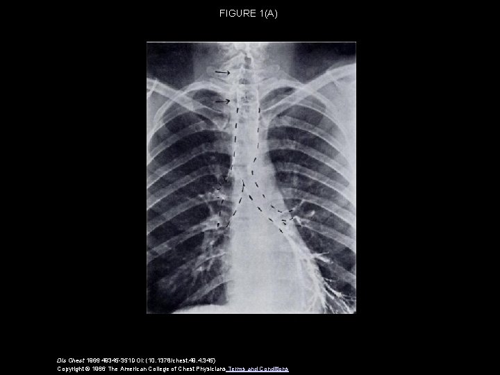 FIGURE 1(A) Dis Chest 1966 49345 -351 DOI: (10. 1378/chest. 49. 4. 345) Copyright